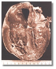 Chronisches Cor pulmonale 