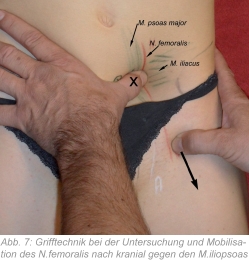 Abb. 7: Grifftechnik bei der Untersuchung und Mobilisation des N. femoralis nach kranial gegen den M. iliopsoas