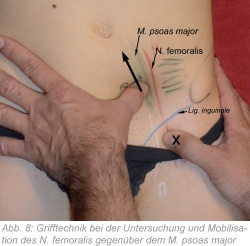 Abb. 8: Grifftechnik bei der Untersuchung und Mobilisation des N. femoralis gegenüber dem M. psoas major