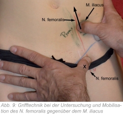 Abb. 9: Grifftechnik bei der Untersuchung und Mobilisation des N. femoralis gegenüber dem M. iliacus