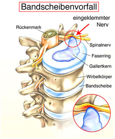 Bandscheibenvorfall