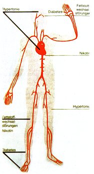 Unterschiedliche Haupt- und Nebenmanifestationen der einzelnen Risikofaktoren an den verschiedenen Gefäßprovinzen