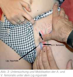 Abb. 3: Untersuchung und Mobilisation der A. und V. femoralis unter dem Lig. inguinale