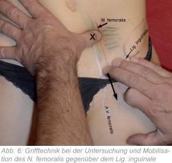 Abb. 6: Grifftechnik bei der Untersuchung und Mobilisation des N. femoralis gegenüber dem Lig. inguinale